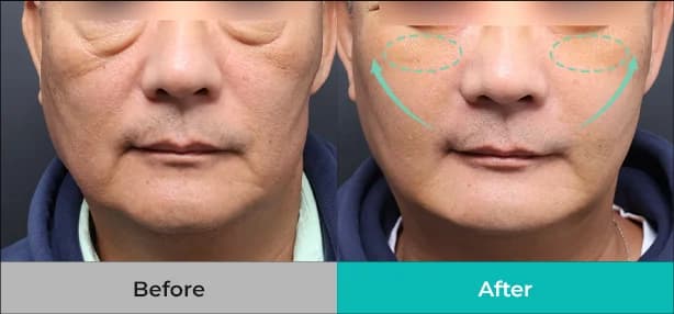 눈 밑과 중안면부의 리프팅 방향을 화살표로 표시한 하안검 중안면부거상 전후 비교 사진