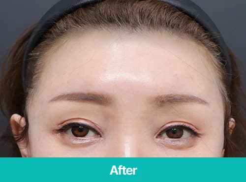 2030대 이마거상술 후 눈꺼풀과 눈썹 위치를 보여주는 After 정면 사진