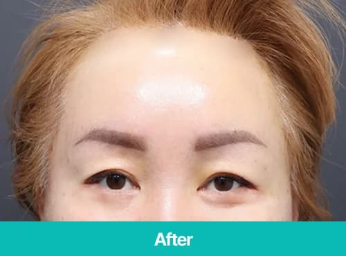 4060대 이마거상술 후 눈꺼풀과 눈썹 위치를 보여주는 After 정면 사진