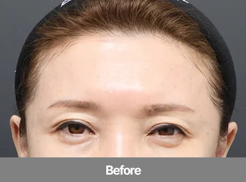 2030대 이마거상술 전 눈꺼풀과 눈썹 위치를 보여주는 Before 정면 사진