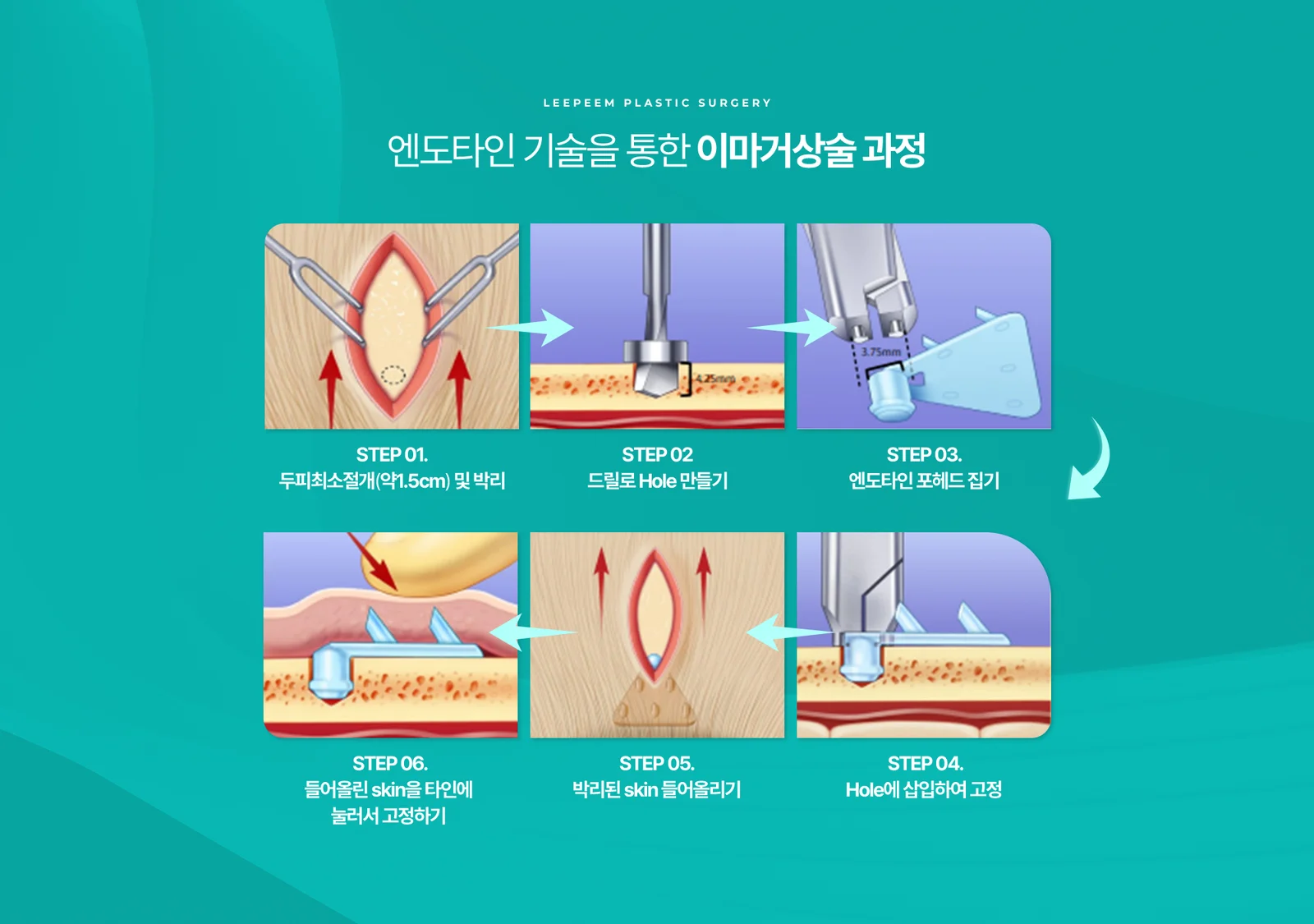두피 최소절개부터 엔도타인 삽입·고정까지 이마거상술 6단계 과정을 순서대로 보여주는 도해