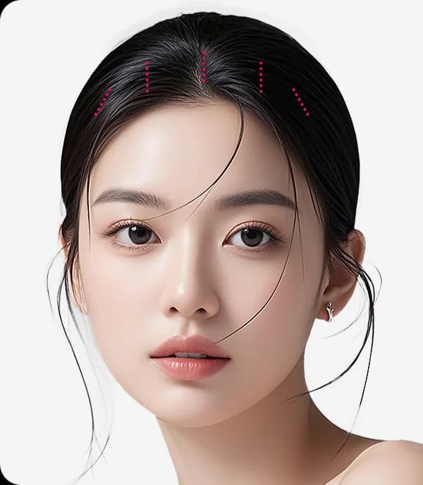 모발선 안쪽에 나눠 배치한 이마거상 절개선을 점선으로 표시한 정면 사진