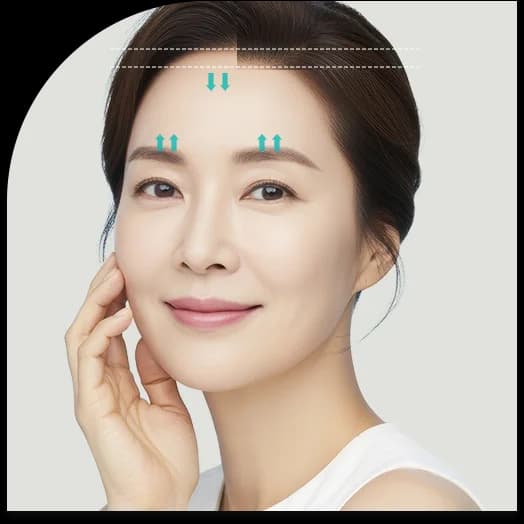 헤어라인을 내리는 방향과 눈썹을 올리는 방향을 화살표로 함께 표시한 정면 사진