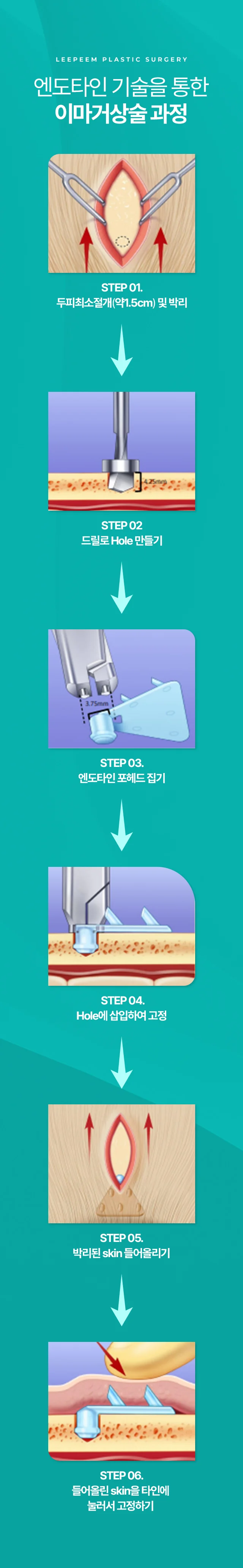 두피 최소절개부터 엔도타인 삽입·고정까지 이마거상술 6단계 과정을 순서대로 보여주는 도해