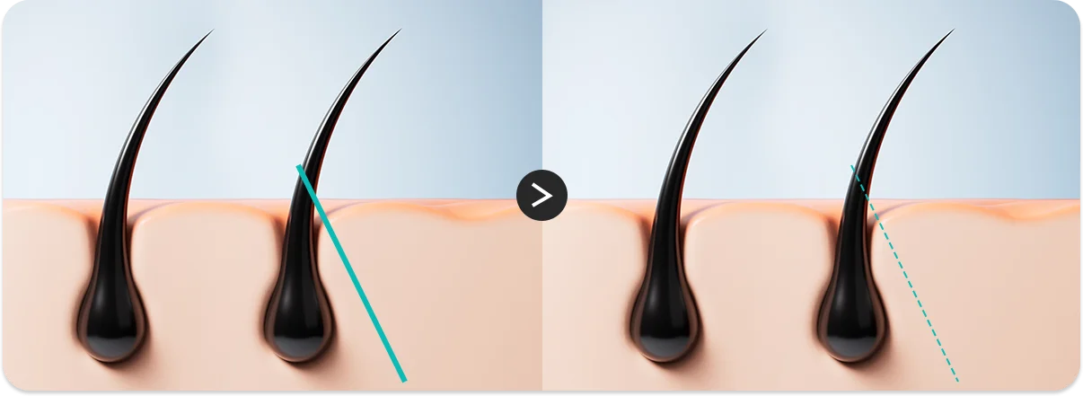 모근을 지나는 수직 절개와 모근을 피하는 사선 절개를 비교한 두피 단면 일러스트