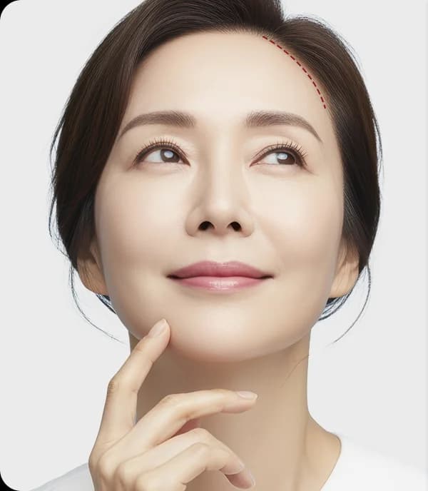 헤어라인을 따라 이어지는 절개선을 붉은 점선으로 표시한 얼굴 사진